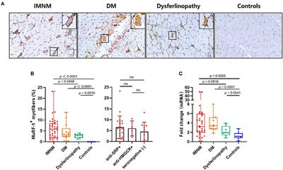 The accumulation of muscle RING finger-1 in regenerating <mark class="highlighted">myofibers</mark>: Implications for muscle repair in immune-mediated necrotizing myopathy